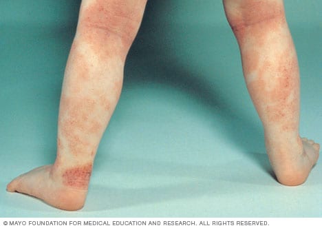 Atopic dermatitis (eczema) - Symptoms and causes - Mayo Clinic