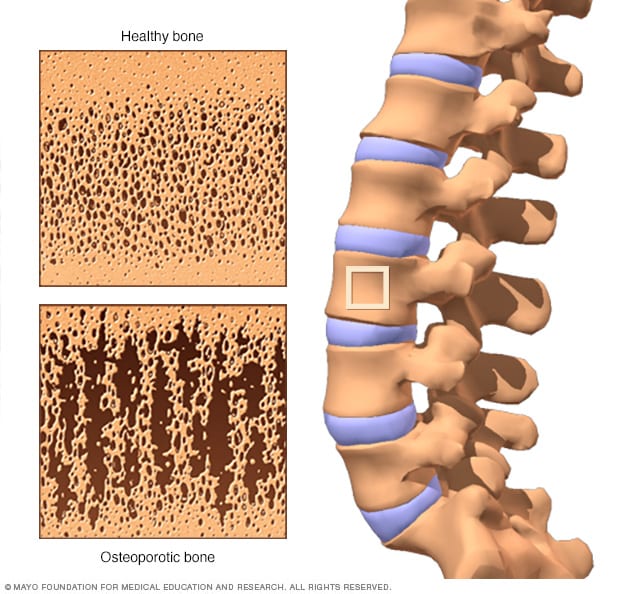 Image result for osteoporosis