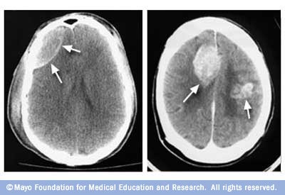 صور لفحص مقطعي محوسب (CT) للدماغ
