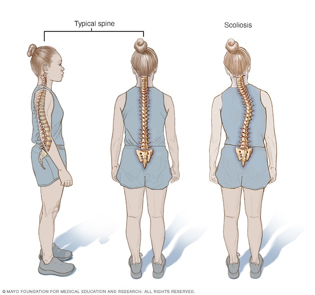 Comparación de las curvas normales de la columna vertebral con la escoliosis