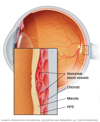 Illustration showing wet macular degeneration 
