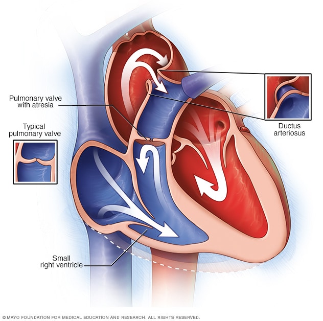 Atresia pulmonar