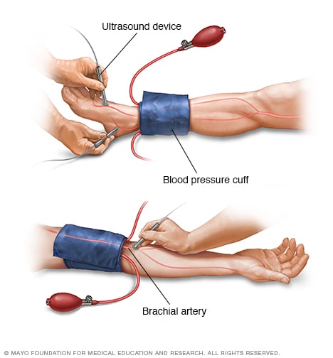 An ankle-brachial index test