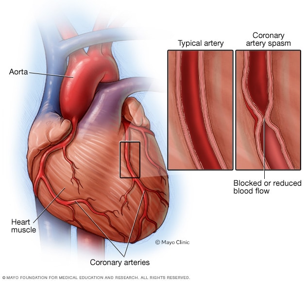 Coronary artery spasm