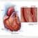 Ilustración de un espasmo de la arteria coronaria
