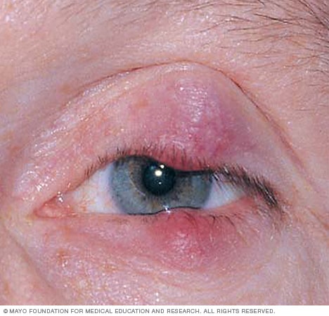 Blepharitis - Symptoms and - Mayo