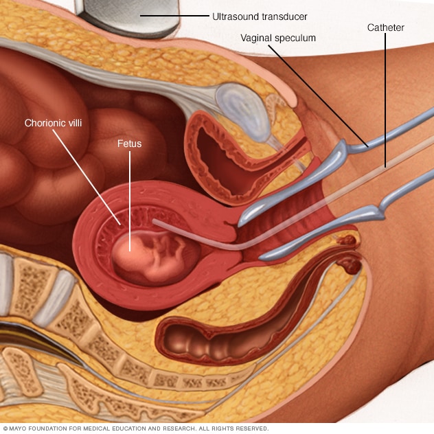 chorionic villus sampling