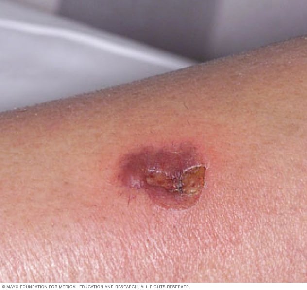 An ecthyma sore