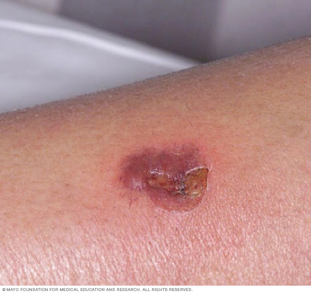 Ecthyma Impetigo Dermatologic Bacteriology Plastic Surgery Key Ecthyma Impetigo Dermatologic Bacteriology Plastic Surgery Key