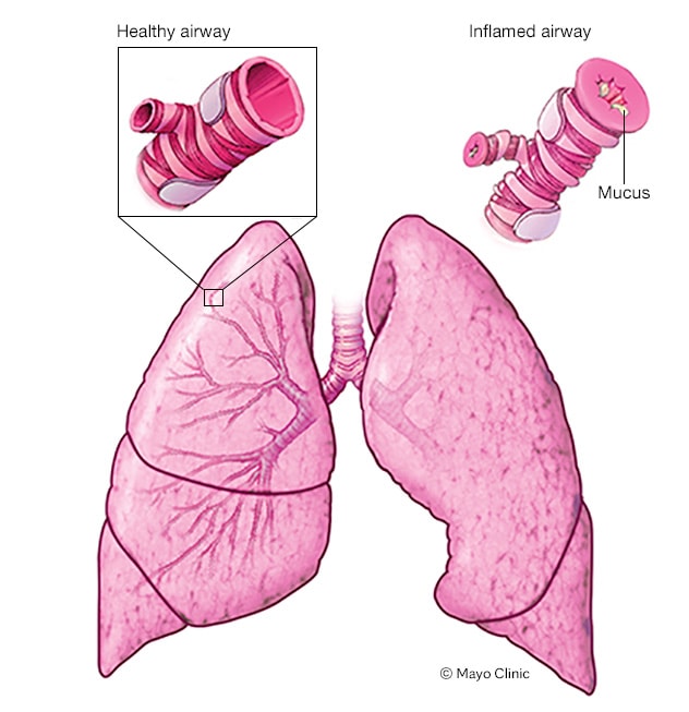 Ilustración de lo que sucede durante un ataque de asma