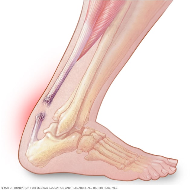 heel pain near achilles tendon