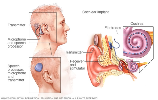 人工耳蜗的工作原理 