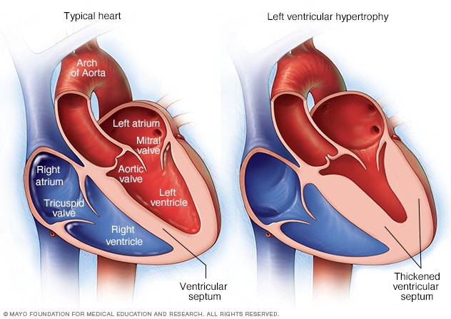 Left ventricular hypertrophy - Symptoms and causes - Mayo Clinic