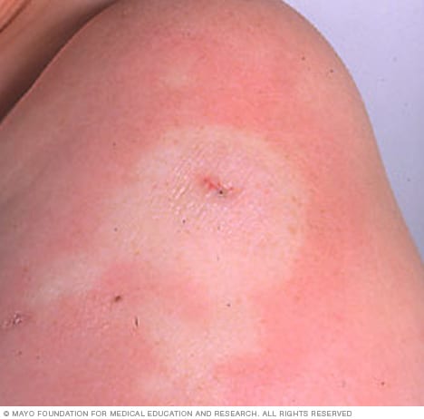 Morphea - Mayo Clinic