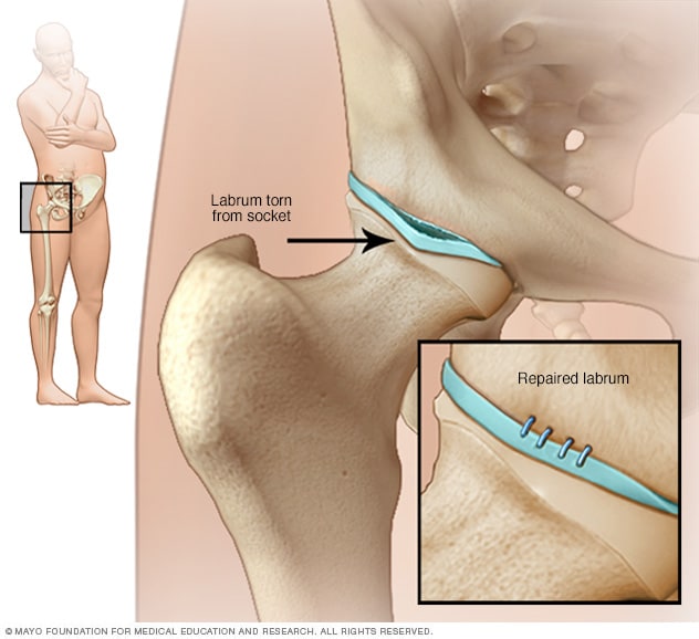 Desgarro del labrum de la cadera