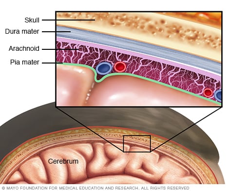 Natural Bacterial Cerebrospinal Meningitis