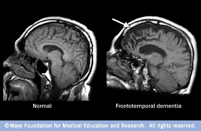 MRI images comparing a normal brain with one showing shrinkage in the frontal lobes.
