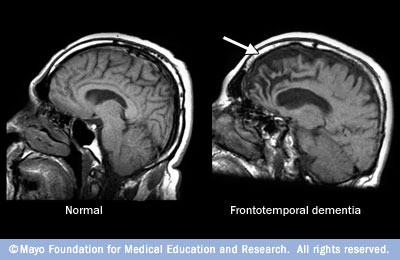 MRI images comparing a normal brain with one showing shrinkage in the frontal lobes.
