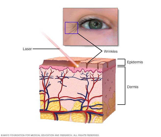 Cómo se realiza la exfoliación por láser