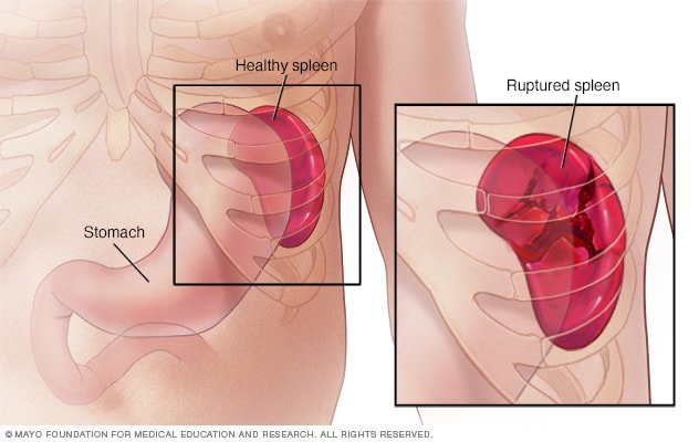 Ruptured Spleen Symptoms And Causes Mayo Clinic