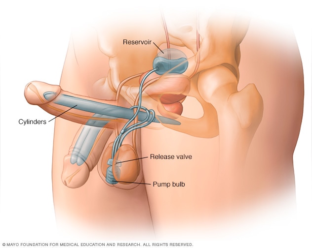 How the penile implant for the 'bionic penis' works