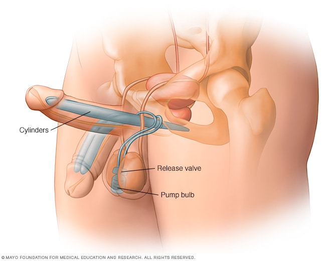 Penis implantat