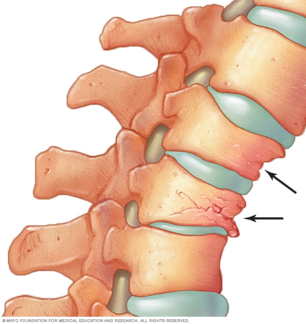 Cómo la osteoporosis puede provocar que las vértebras se aplasten y colapsen