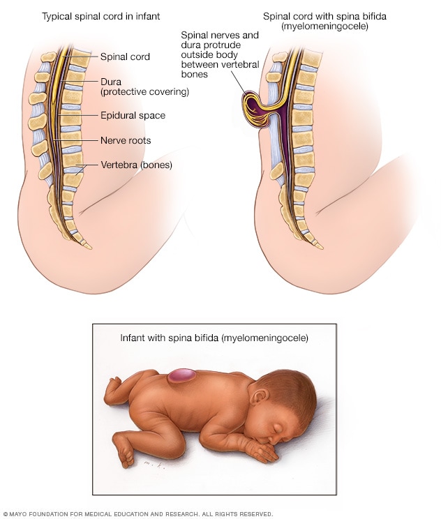 Typical spinal cord and spina bifida