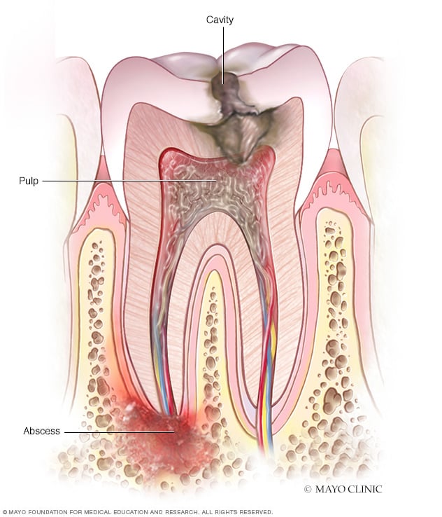 Periapical tooth abscess