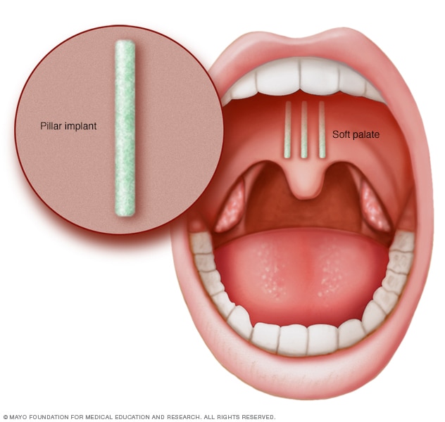 Pillar procedure Mayo Clinic