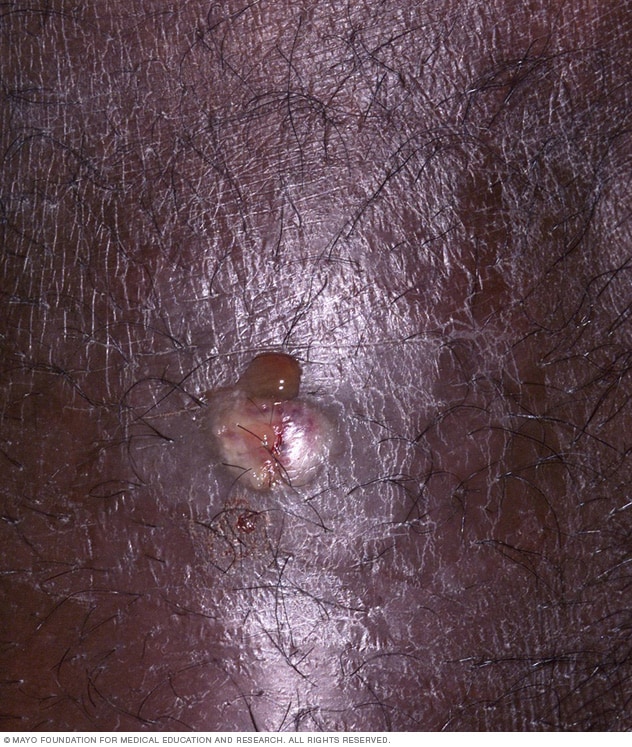 Image showing boil 
