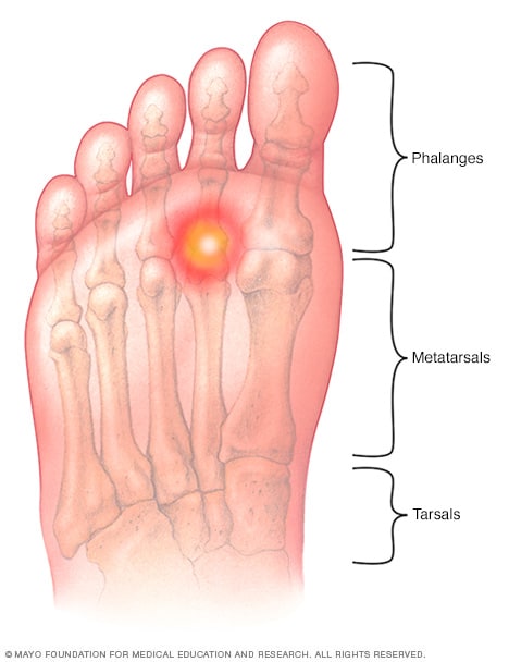 sore spot on sole of foot