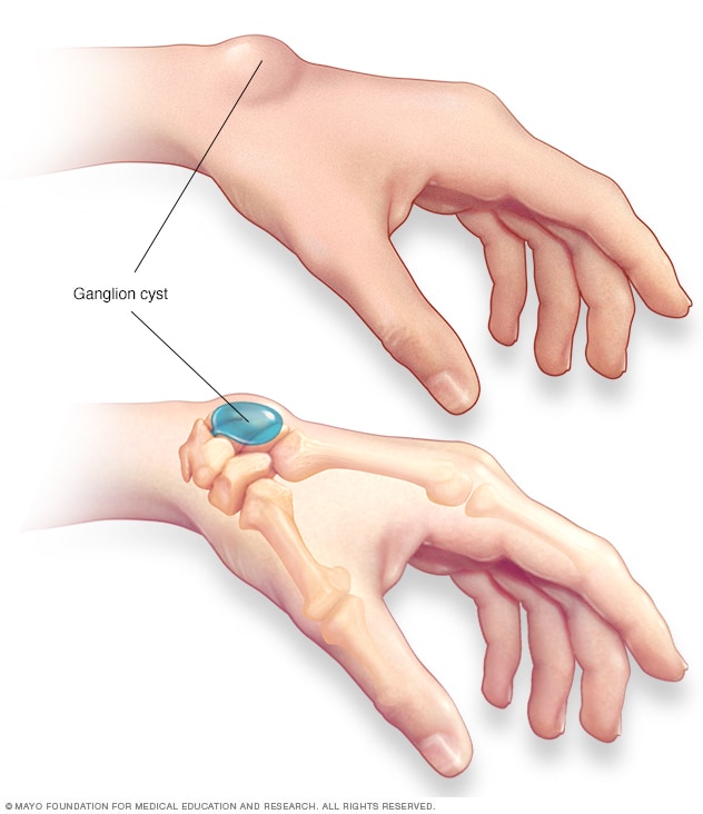 Ganglion cyst Mayo Clinic