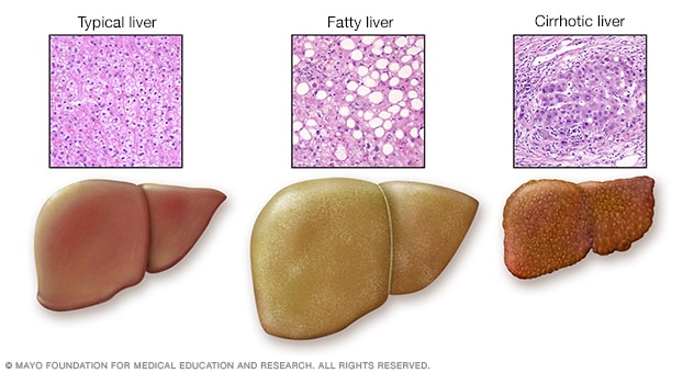 Liver problems showing normal and diseased livers 