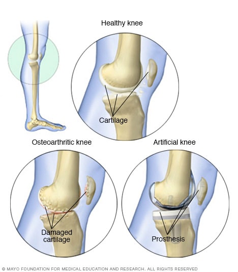 Knee replacement - Mayo Clinic