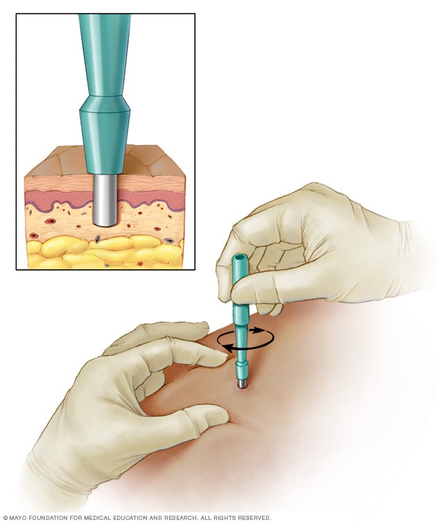 Biopsia con sacabocados