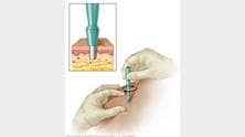 Ilustración de biopsia en sacabocados de la piel 
