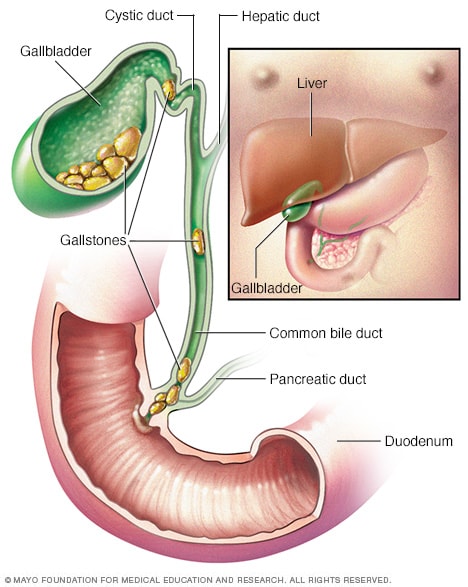Cholecystitis Nursing Care Management And Study Guide