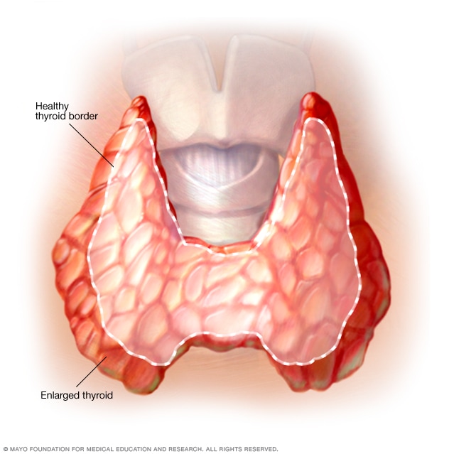 Enlarged thyroid