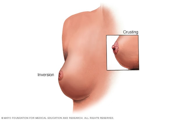 Pagets disease of the breast