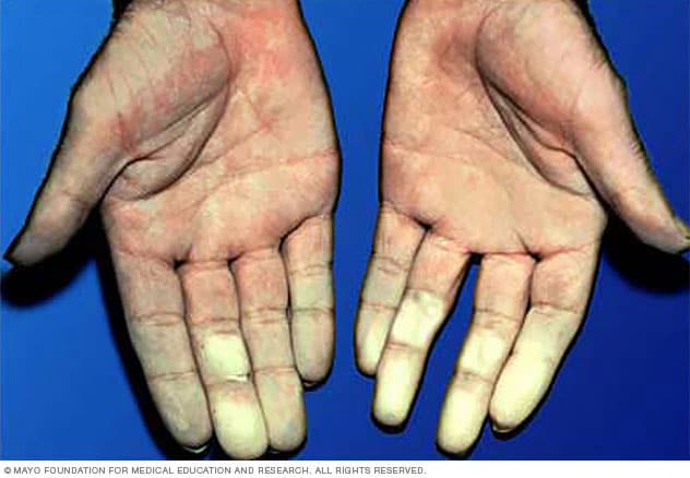 Fenómeno de Raynaud, Síndrome ou Doença de Raynaud