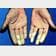 Hands affected by Raynaud's disease