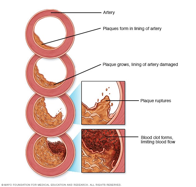 Illustration showing development of atherosclerosis