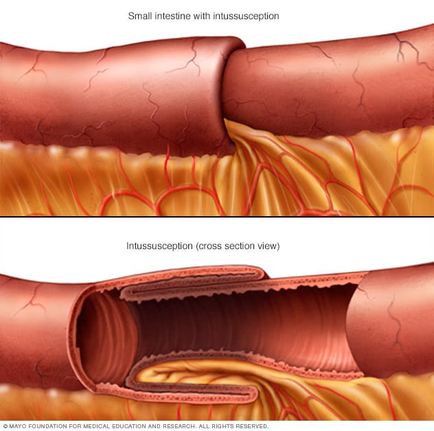 Intussusception - Symptoms and causes - Mayo Clinic