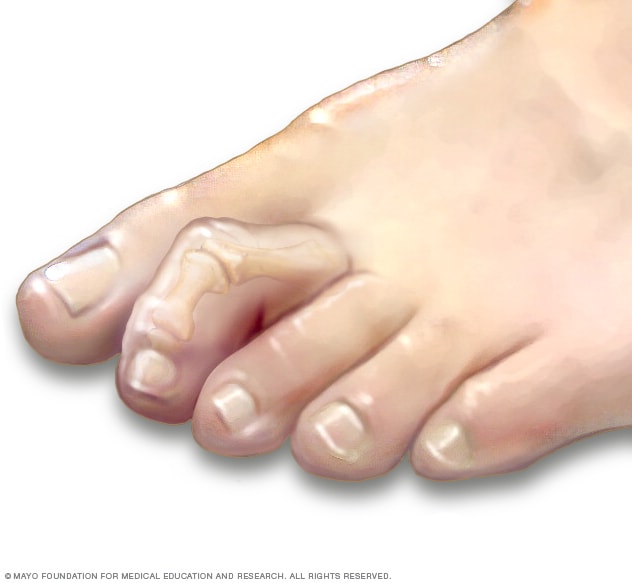 What do hammertoes look like?