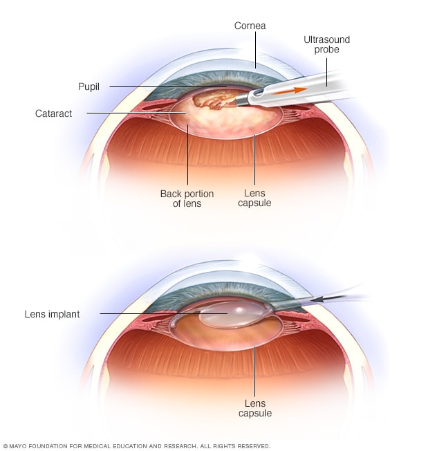 Cataract Surgery Eye Drops Chart