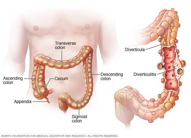 Diverticulosis and diverticulitis - Mayo Clinic