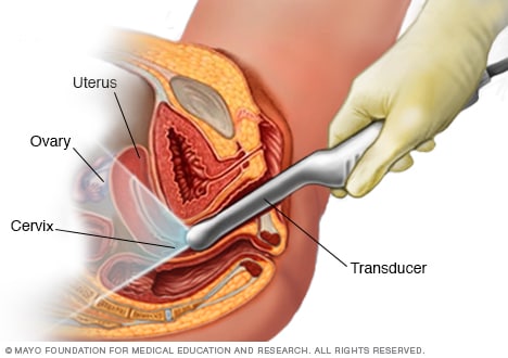 Transvaginal ultrasound - Mayo Clinic