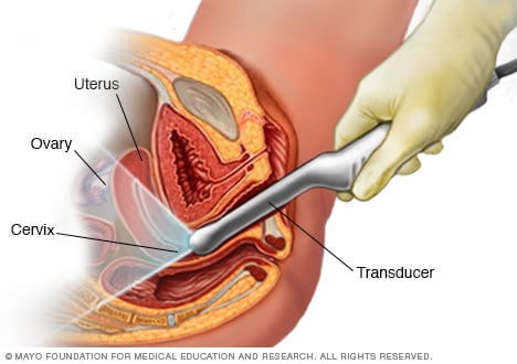 How a transvaginal ultrasound is performed