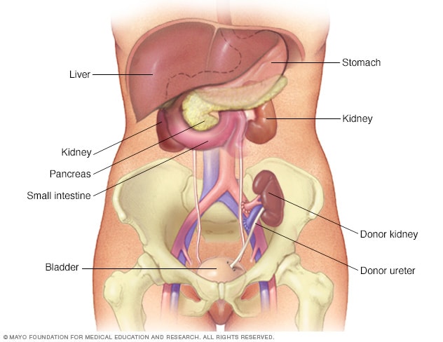 Kidney transplant